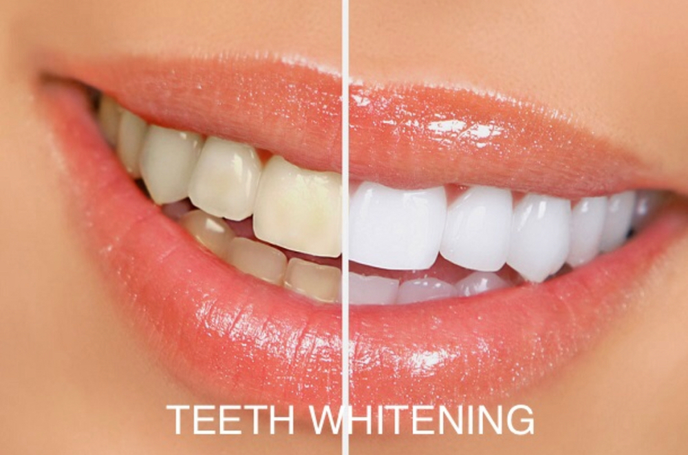 Teeth Whitening Three Applications