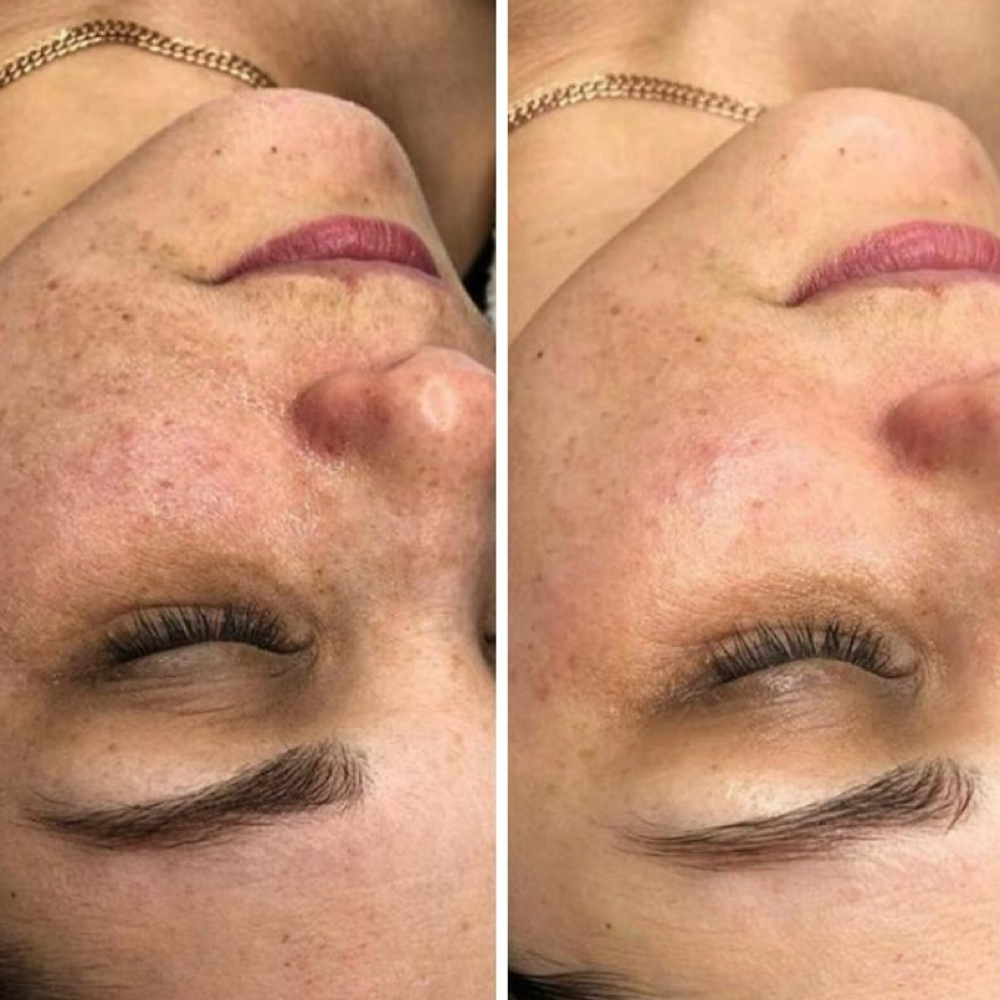 Microdermabrasion Facial at Maine Glow Co. in Fairfield, ME