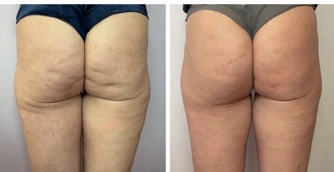 Cellulite Injections