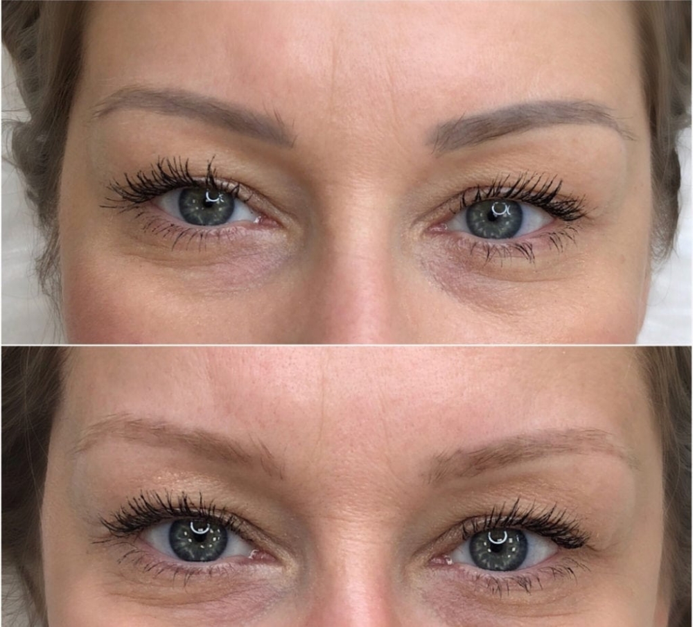Brow Removal (Previous Work)