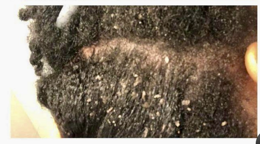 Scalp Treatment