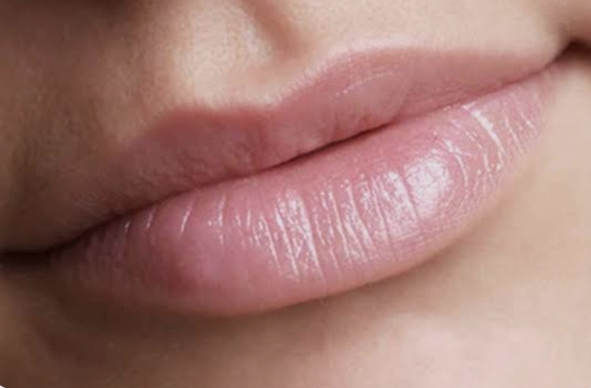 Lip Filler