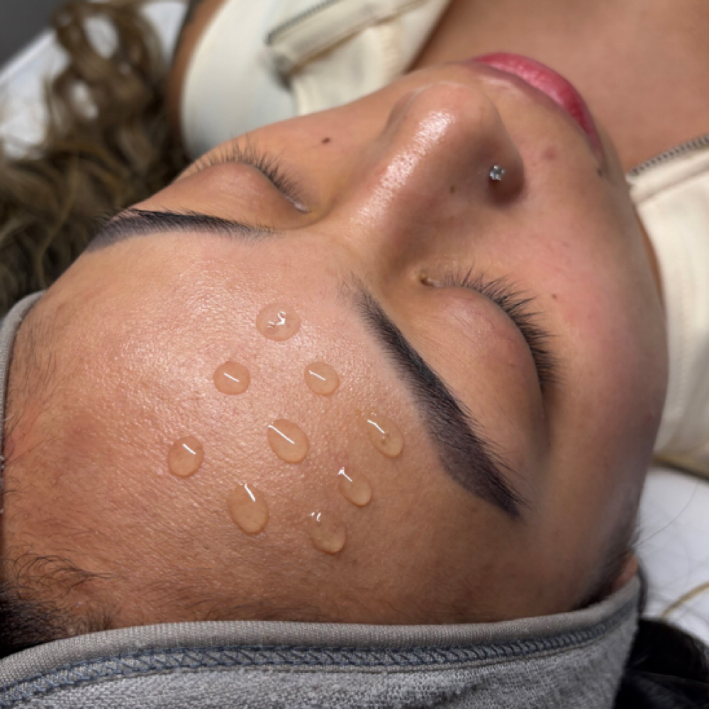 Salmon Sperm Microneedling at TSWL in Tempe, AZ