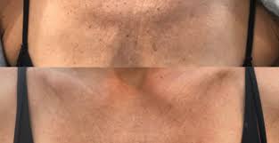 Chemical Peel - Décolletage (chest)