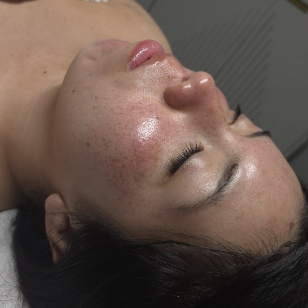 A1 Chemical Peel at Stephs A1 Beauty Bar in Southwest Ranches, FL