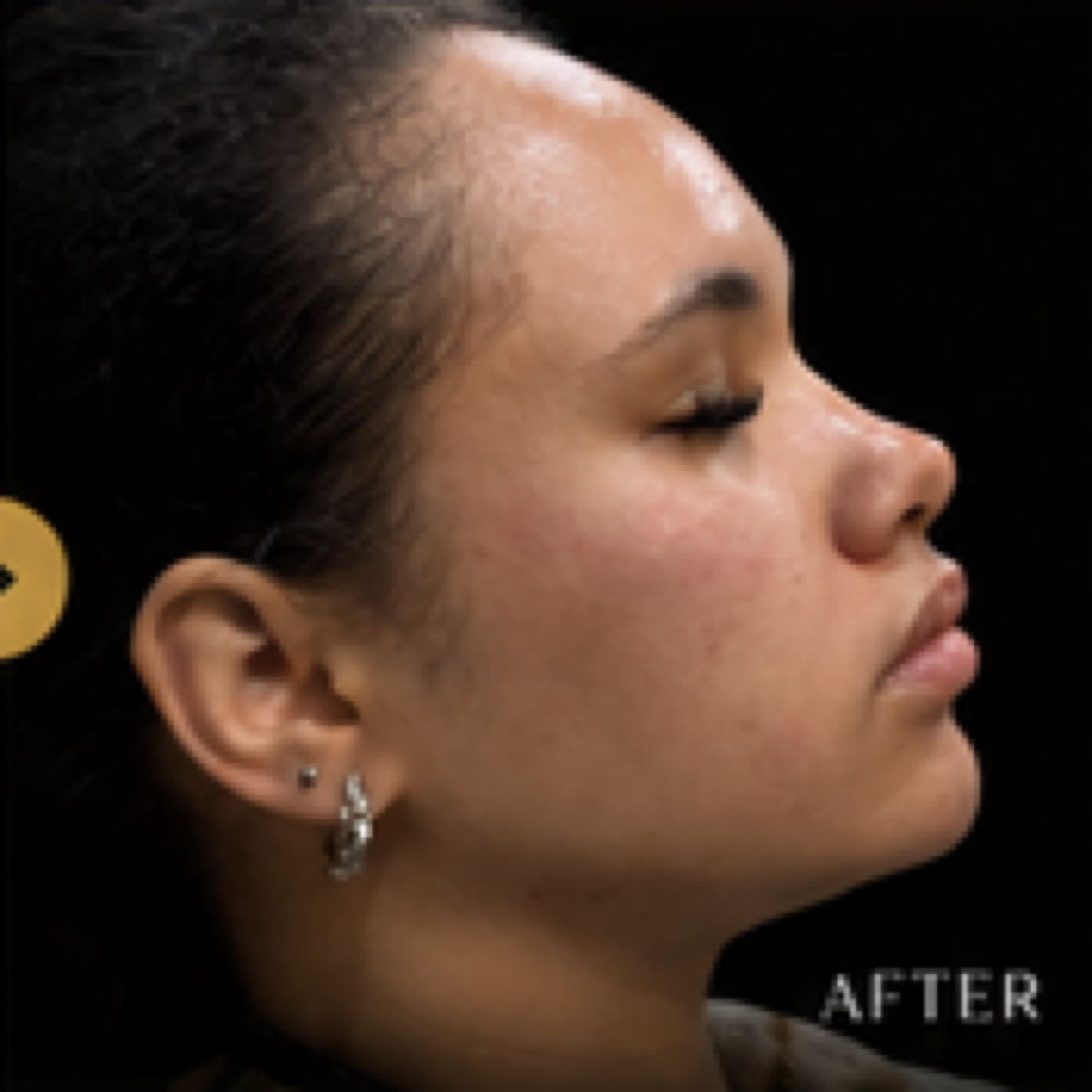 Facial Balancing at Enliven You Aesthetics & Wellness in Dallas, TX