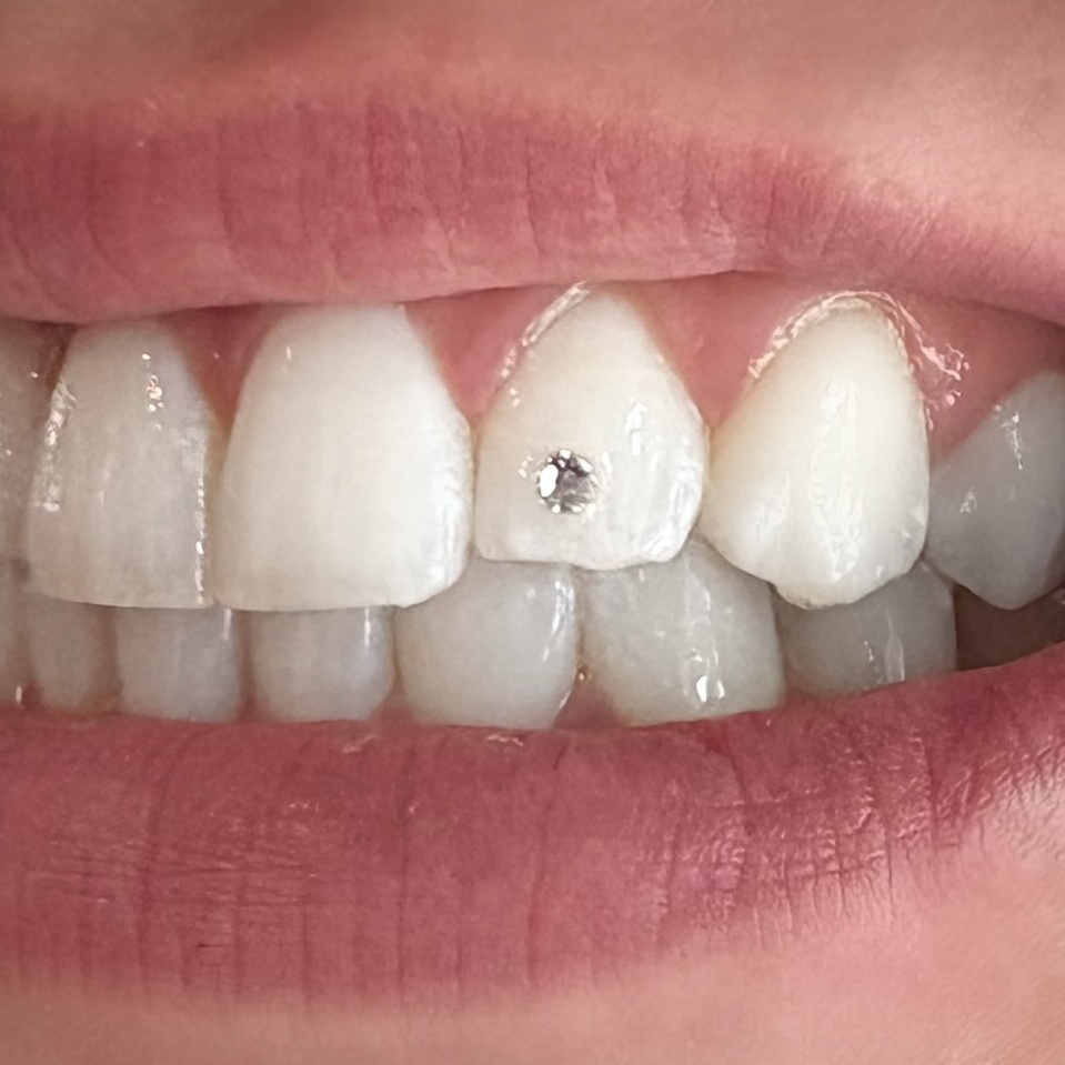 Tooth Gem (Single Crystal)