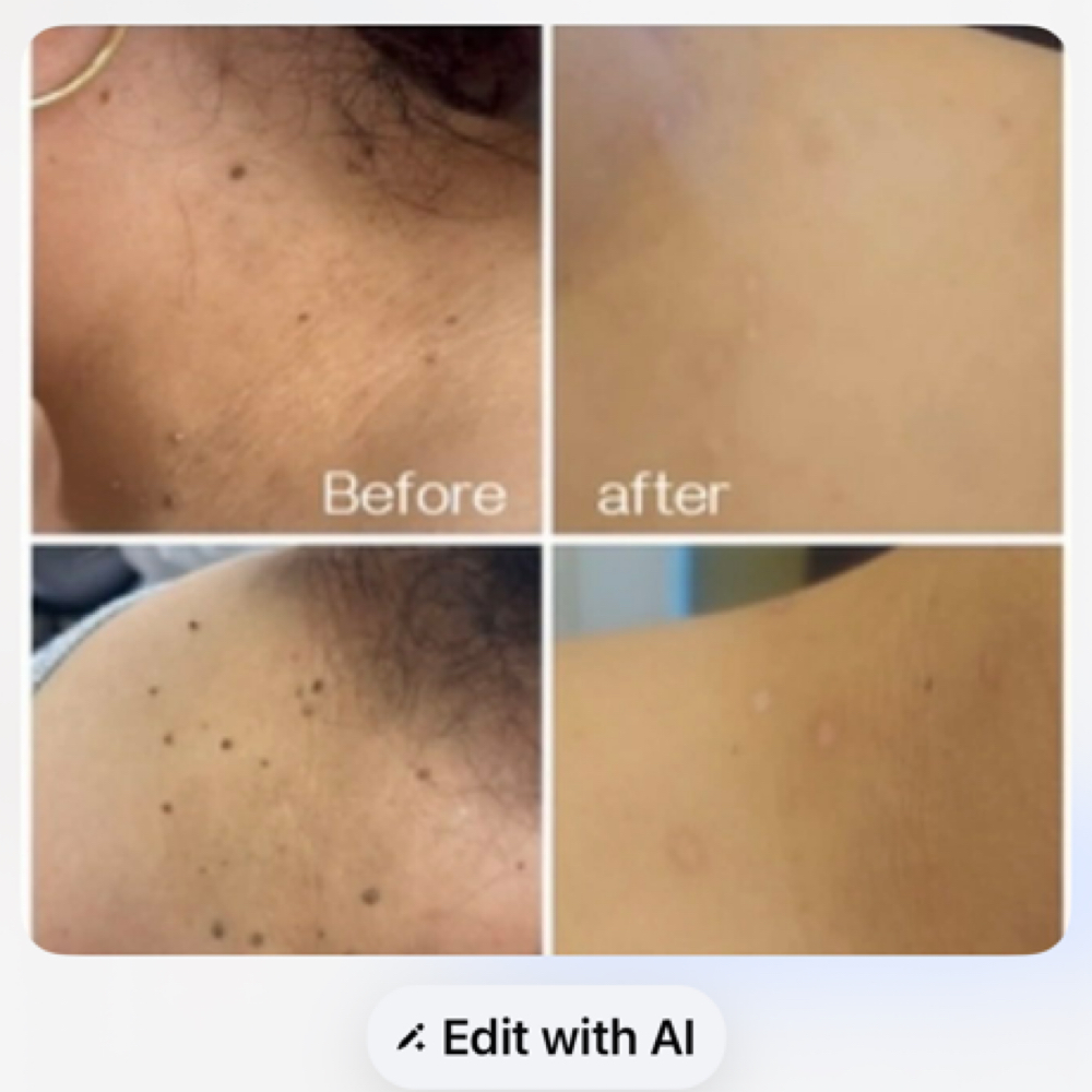 Skin Tag at Excellent Nails By Sandy in California, CA