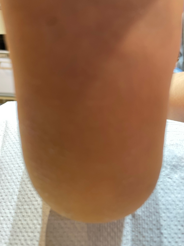 Mobile Heel Repair Treatment