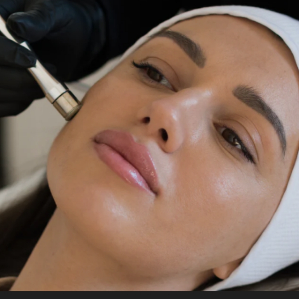 Microdermabrasion Treatment ONLY