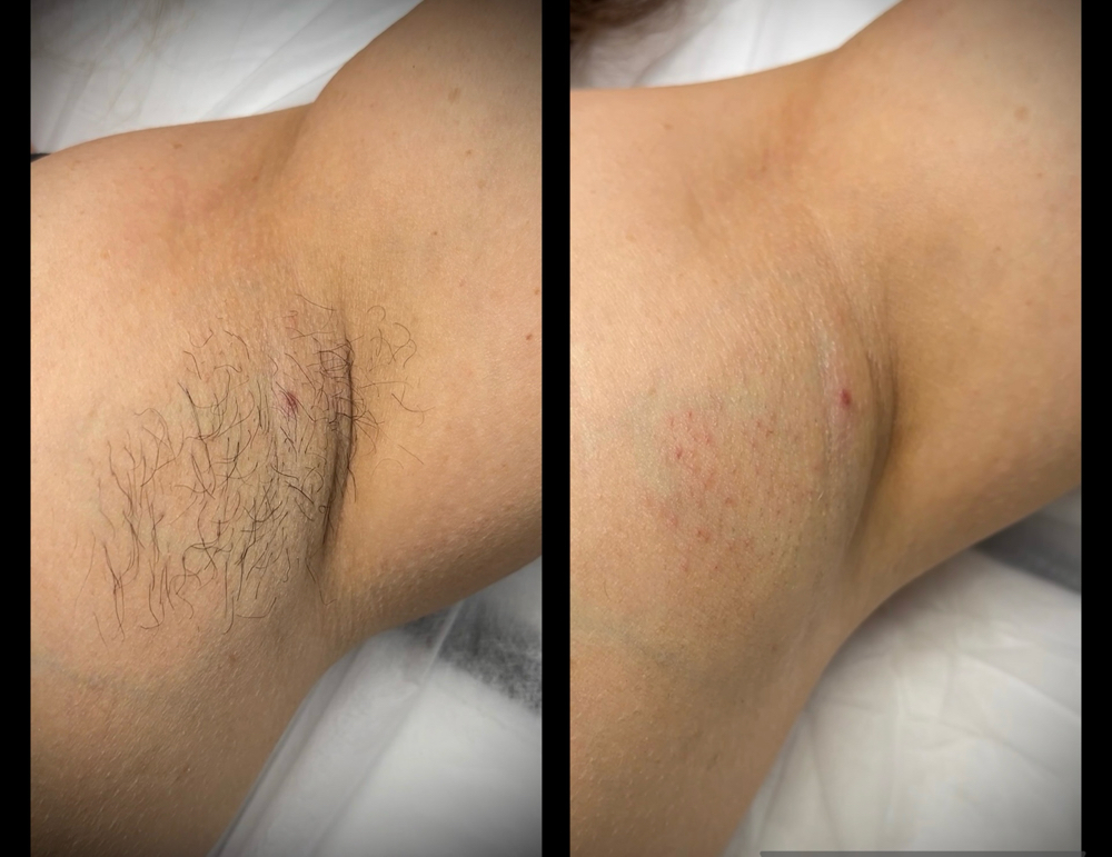 Underarm Waxing at AZOL BEAUTY in Phoenix, AZ