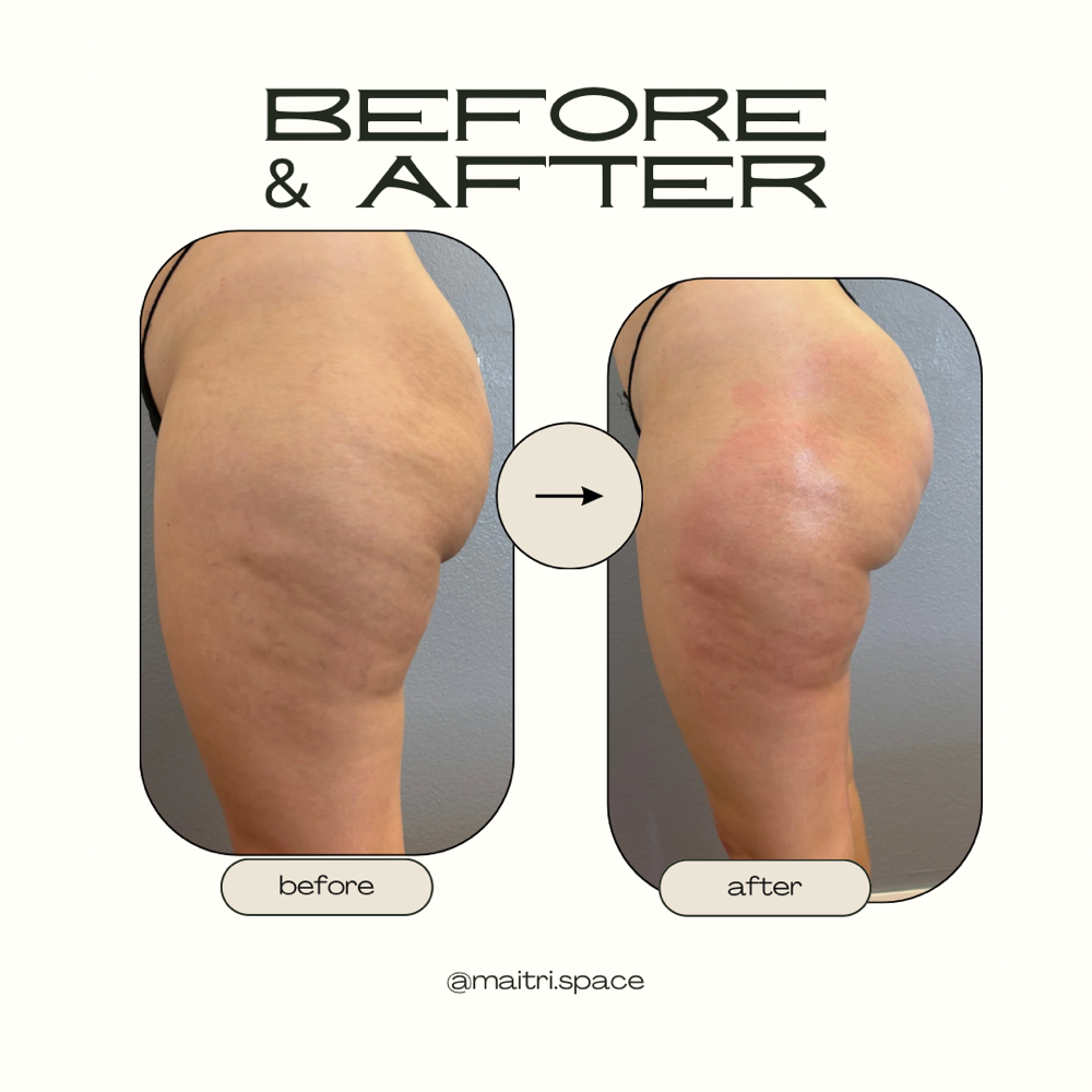 Body Sculpting- Butt lift