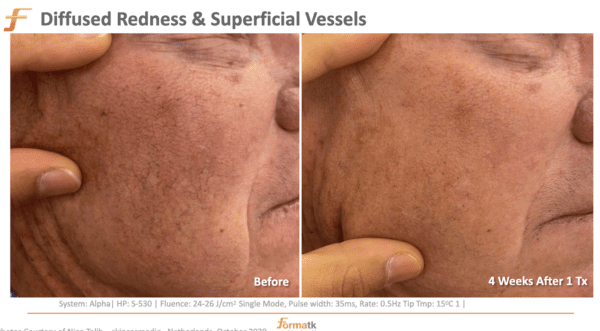 Vascular Lesions - Face at Elegant Esthetics By Jozlyn in Lamar, CO
