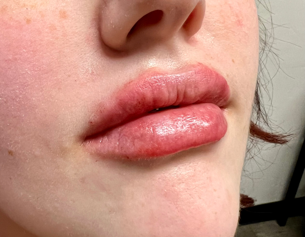 Hya-Pen Filler Full Syringe (1.0ml) at Beauty by Laura ๐ in Warr Acres, OK