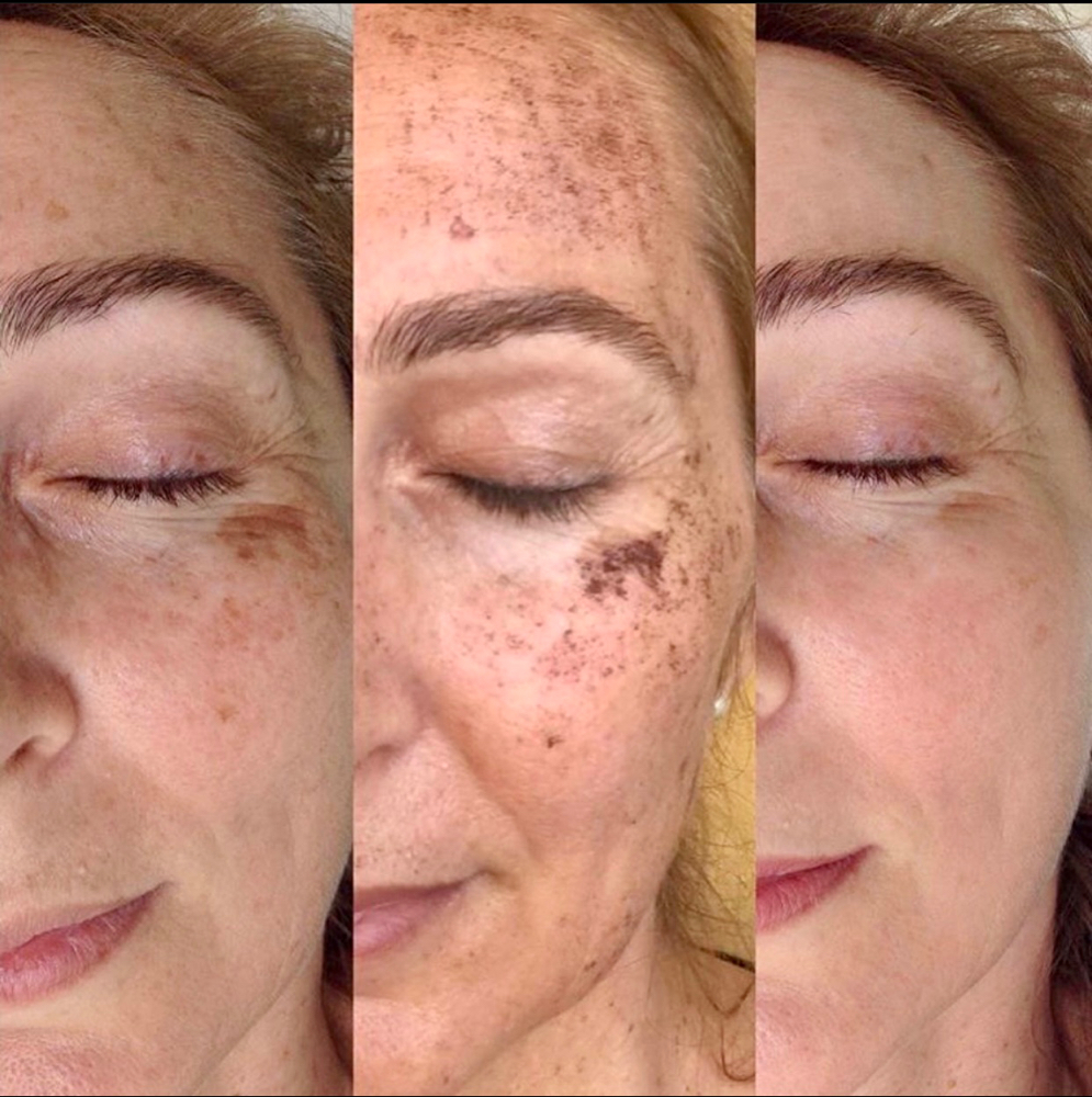 IPL MELASMA Treatment