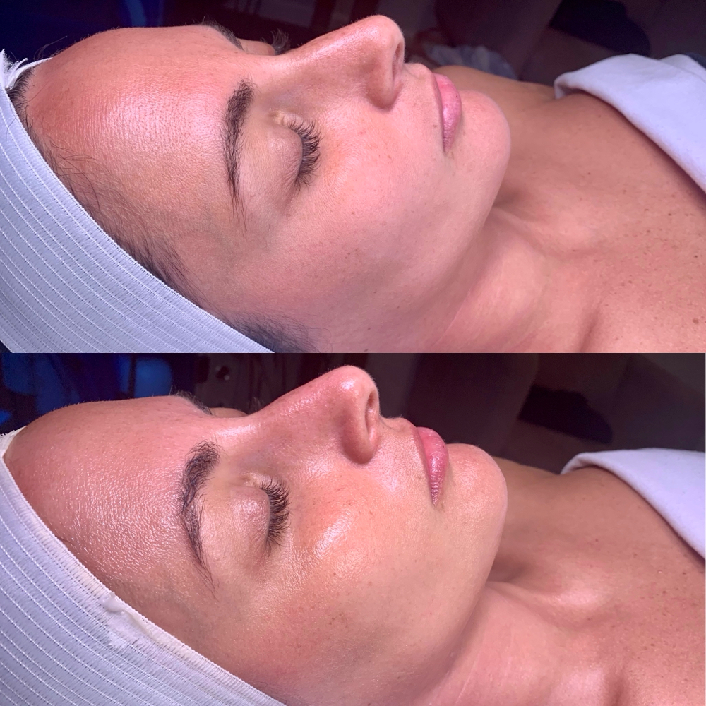 Deluxe Hydrafacial (45 minutes)