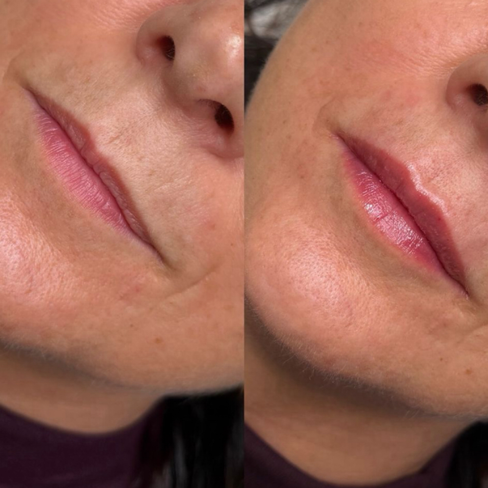 0.5 ml Lip Filler at Atlas Beauty Haven in Brownsville, TX