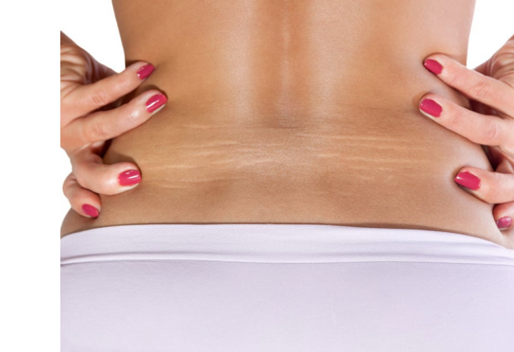 Lower Back Stretchmark Camouflage