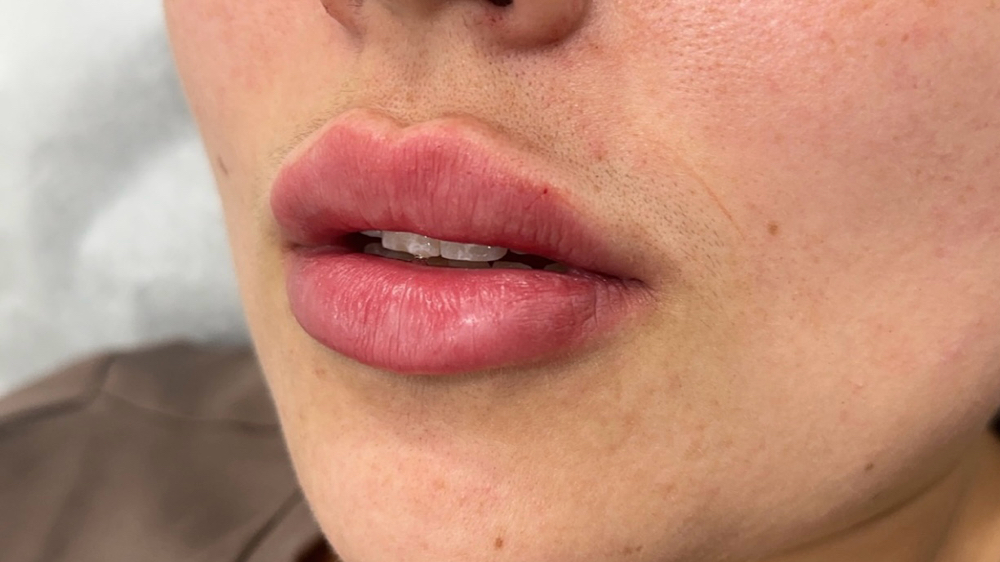 Lip Filler