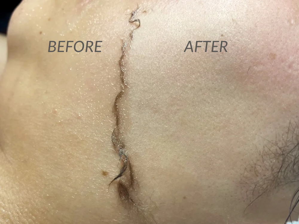 Dermaplaning Add On