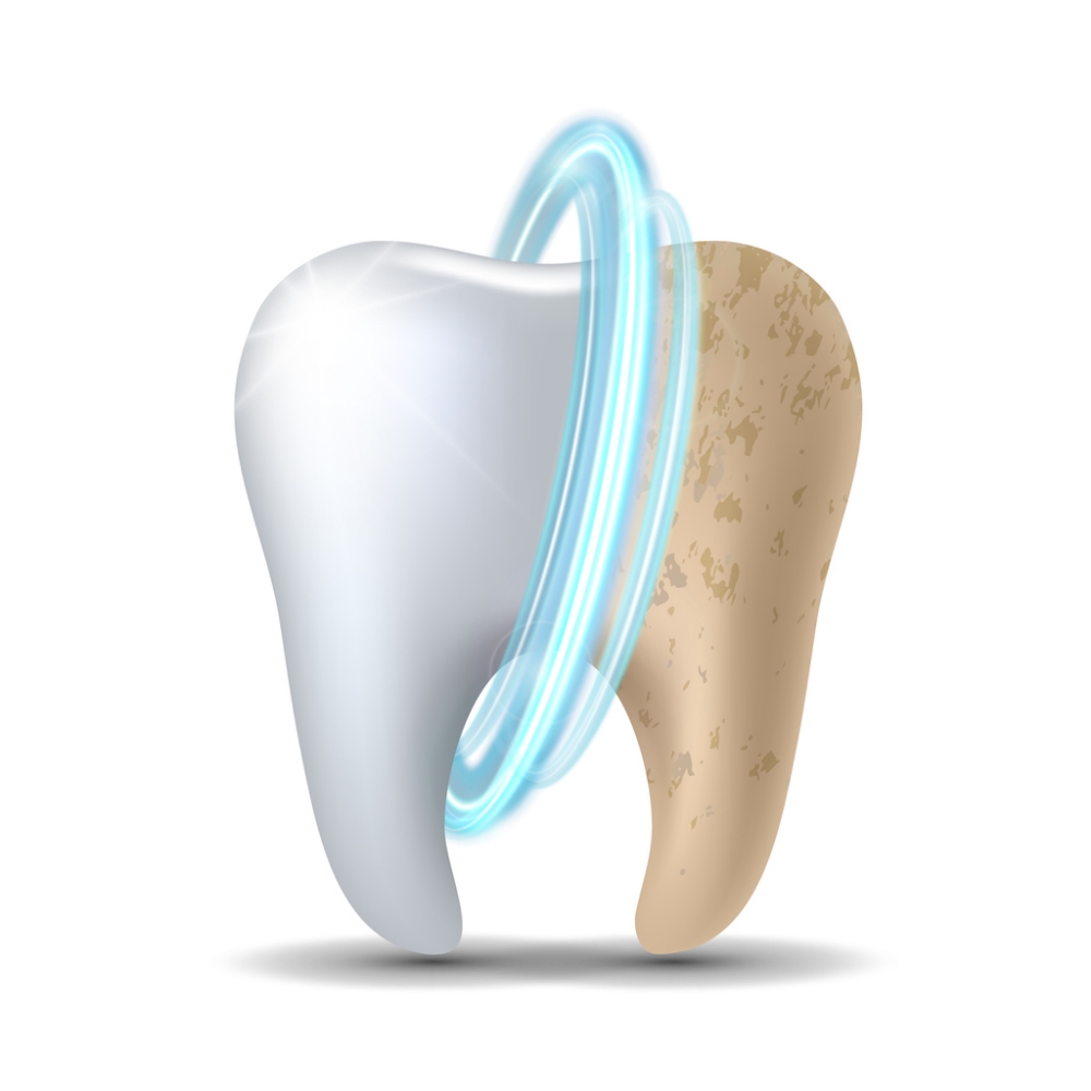 Advanced Teeth Whitening