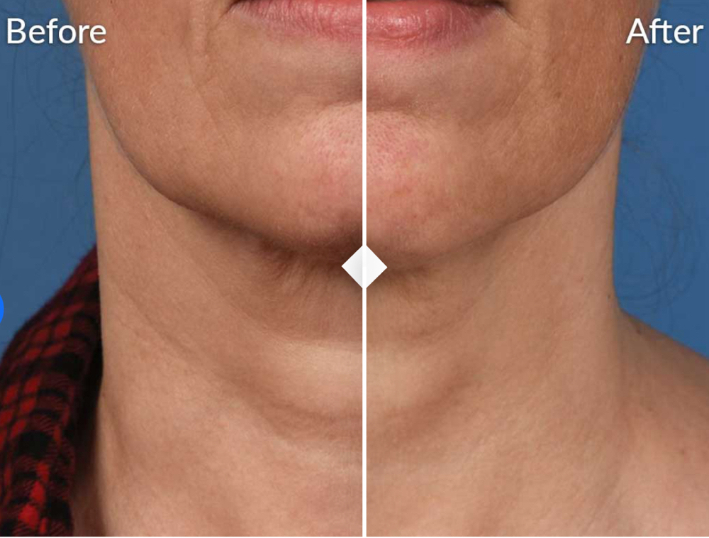 Microneedling- Body