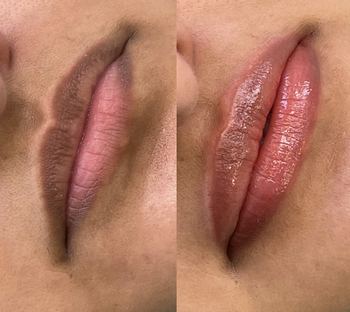 Lip Neutralization 💋