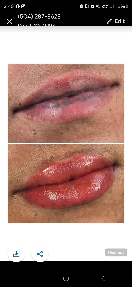 Lip Neutralization 💋