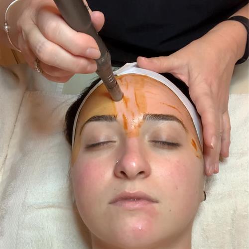 The Revitapen Facial