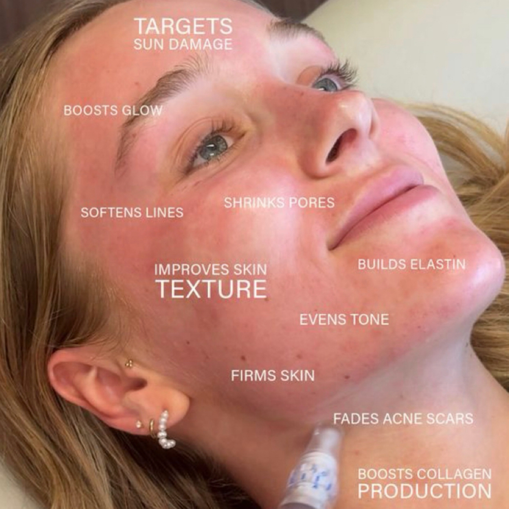 MICRONEEDLING WITH PRP ✨ at The Skin Room Med Spa in Marshall, TX