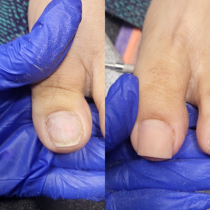 Acrylic Fix Toenail at Nails_by_Ethel in Monessen, PA