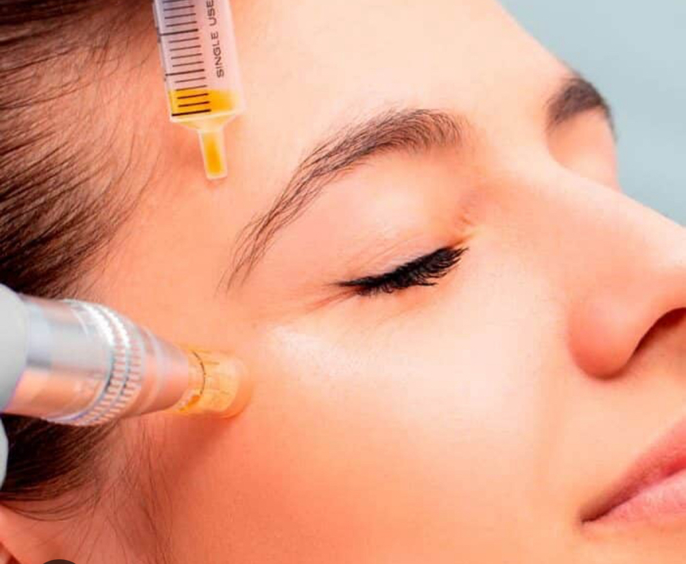 Microneedling