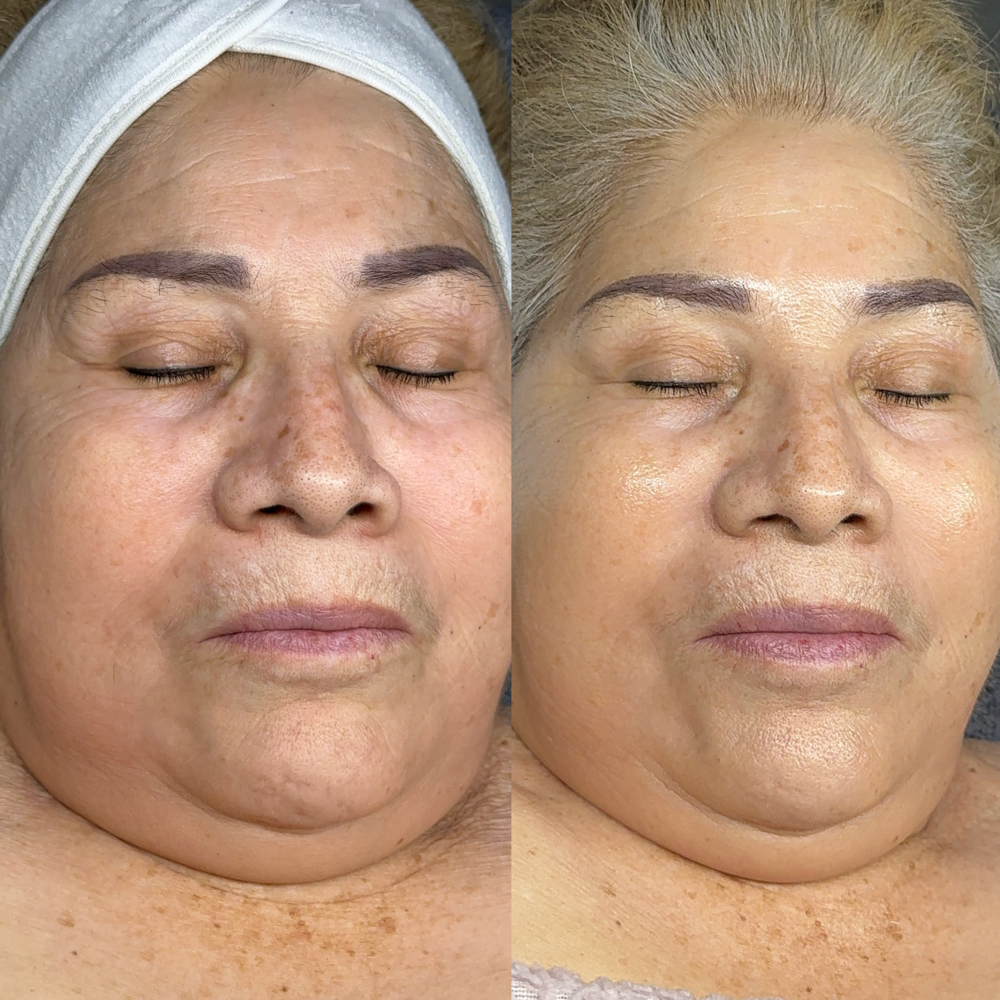 “NO TOX” ANTI AGING