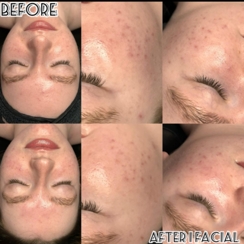 Skin Consultation + First Treatment