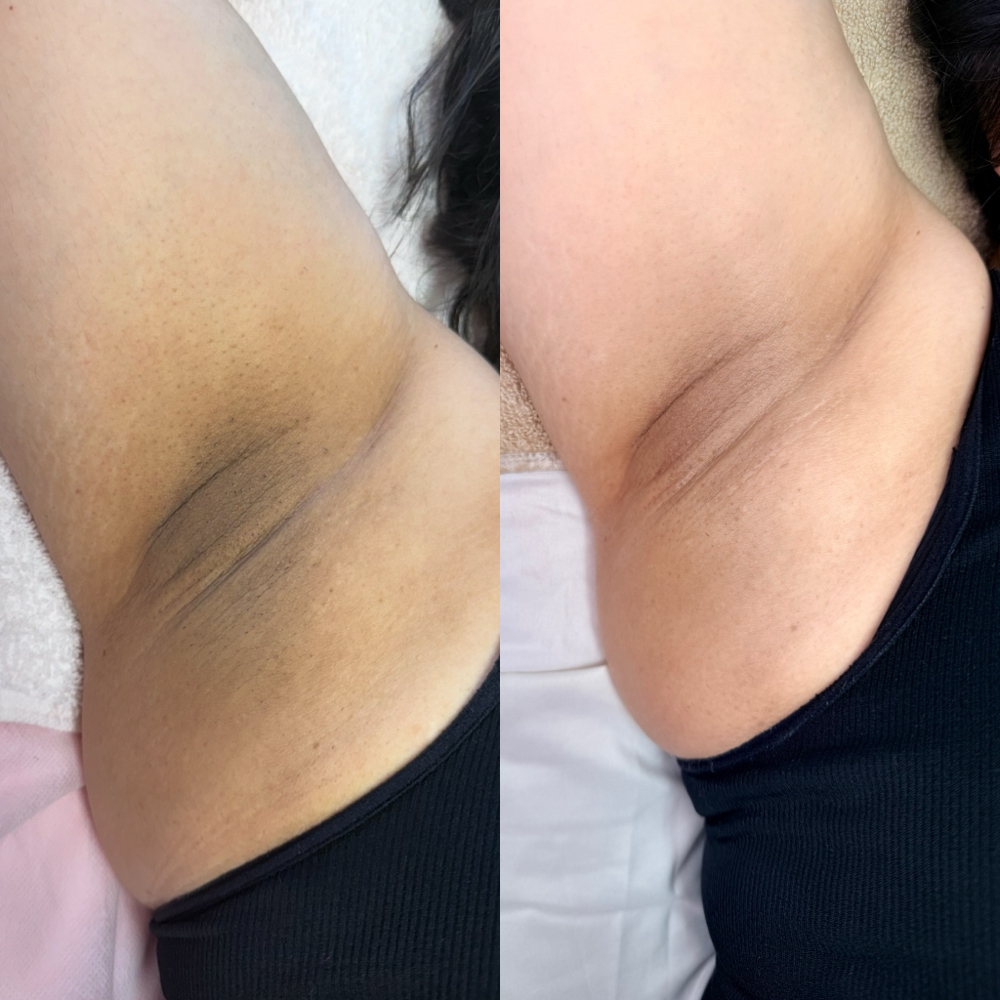 Underarm Lightening at Triple B in La Porte, TX