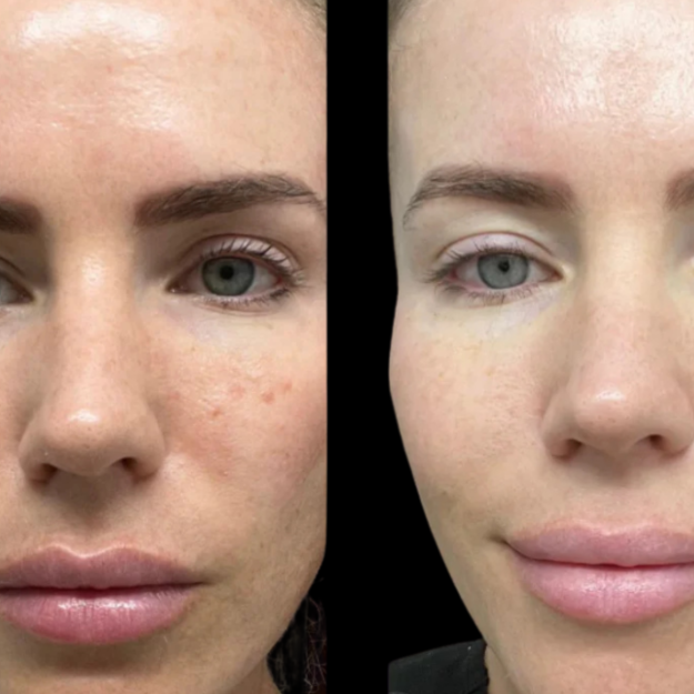 PRX Facial at The Skin Concierge in Northbrook, IL
