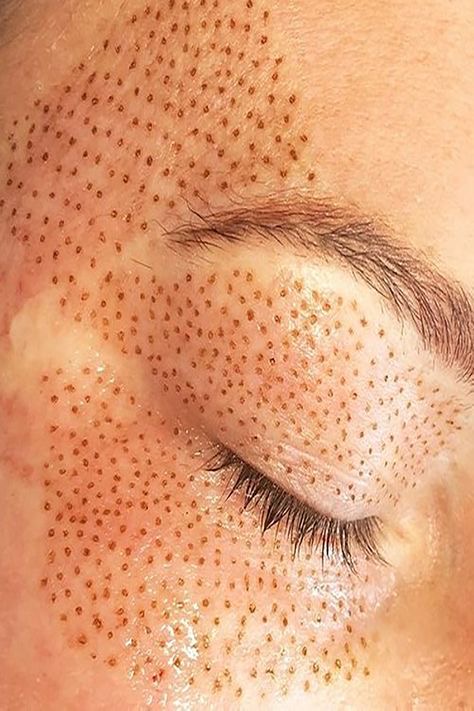 PLASMA FIBROBLAST SKIN TIGHTENING