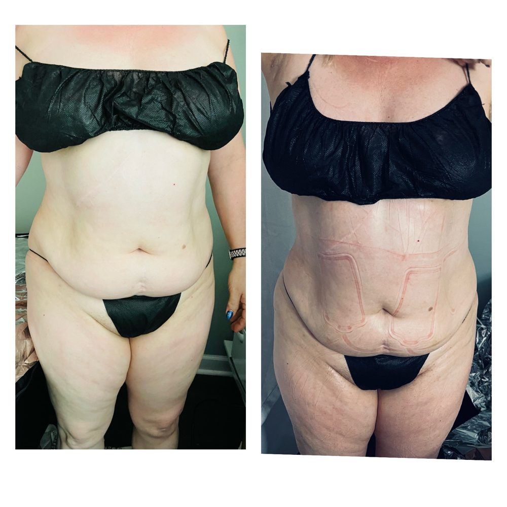 Body Contouring