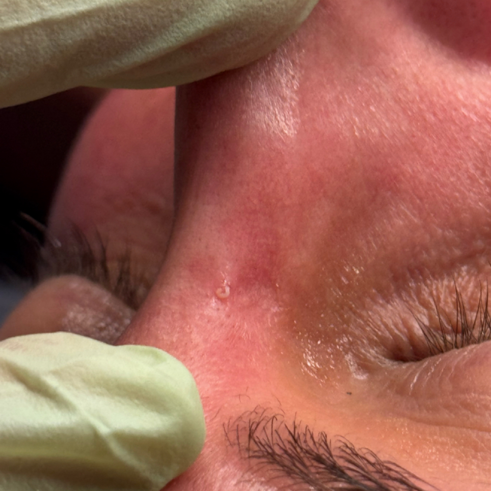 Additonal Extractions at Services By Kelsey | Esthetician in Beavercreek, OH