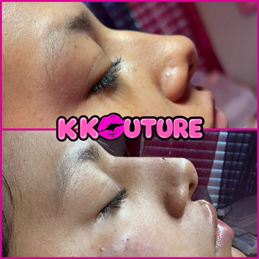 Non Surgical Rhinoplasty at k kouture in Fort Worth, TX