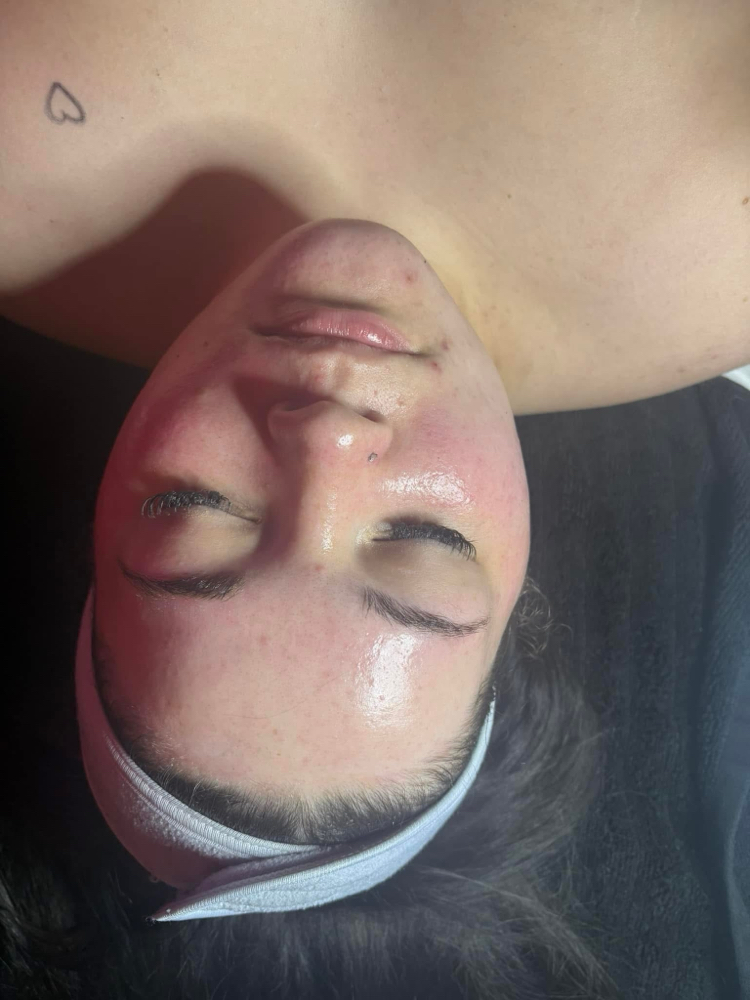 Dermaplane Facial