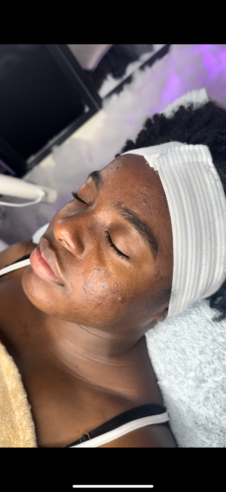 Acne Treatment Facial