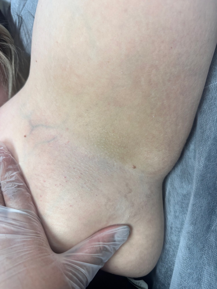 Underarm Bundle