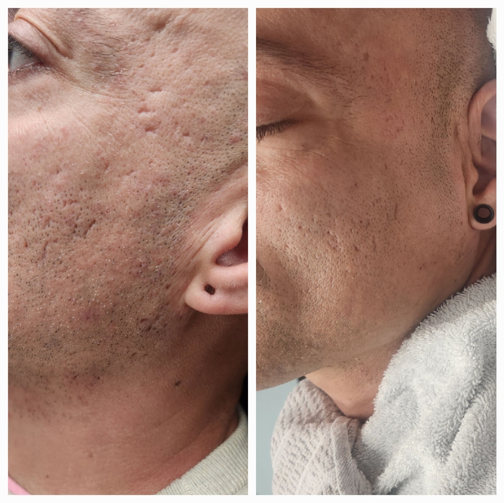 Microneedling With PRF