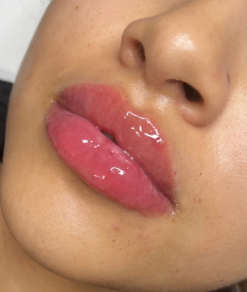 Needle-less Lip Filler