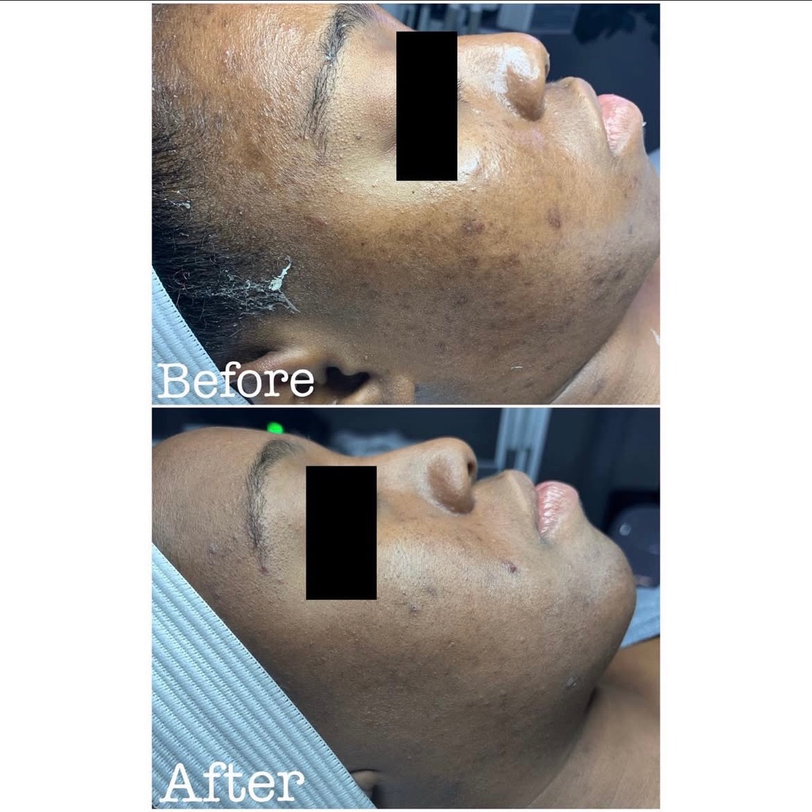 Chemical Peels
