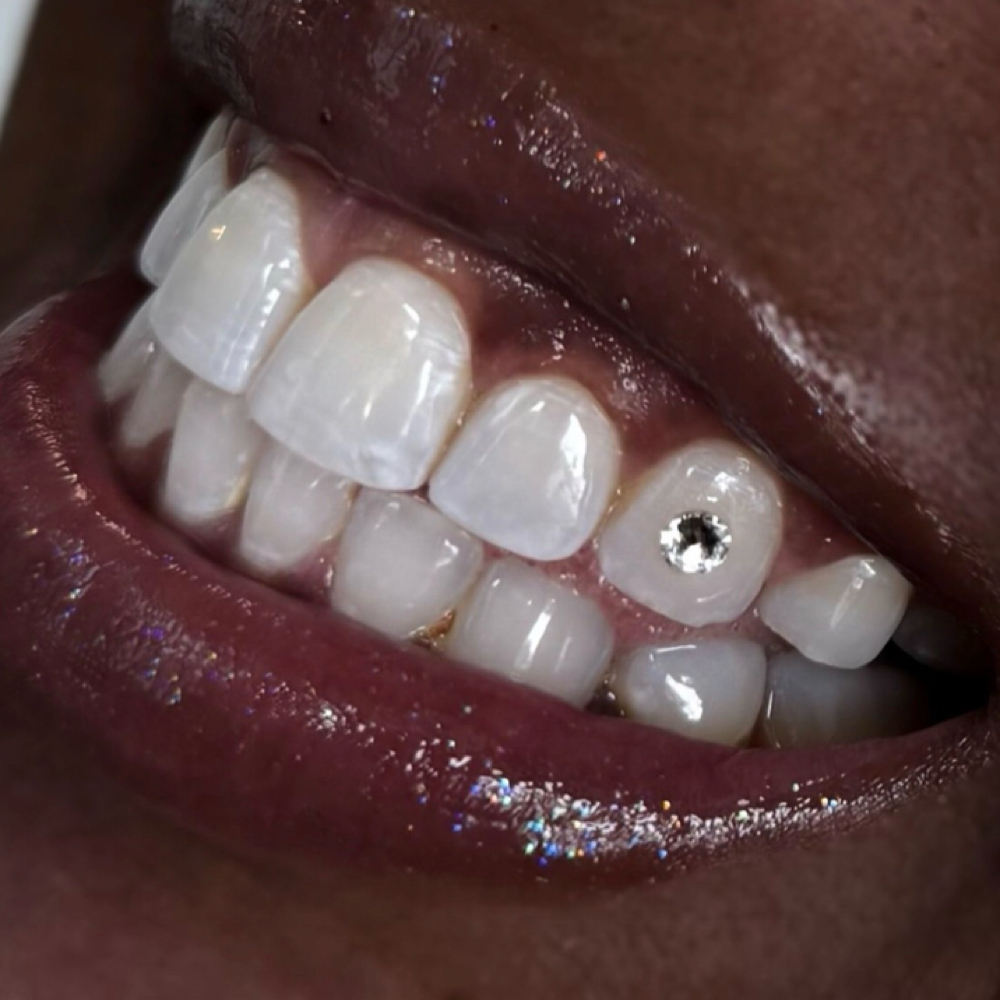 Teeth Gem and Whitening at Jaycie.The.Esti in Abilene, TX