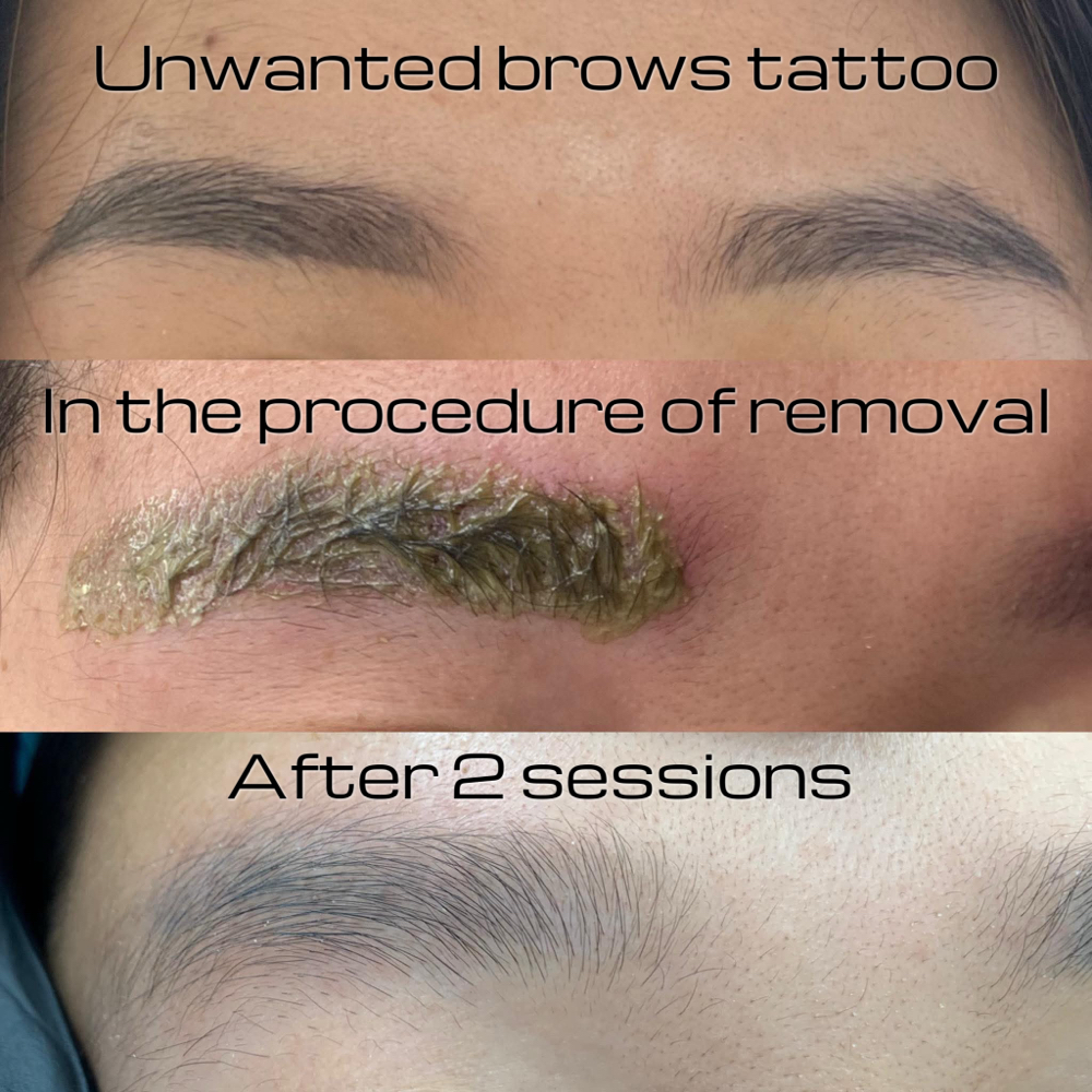 Brow Tattoo Removal (Rejuvi)