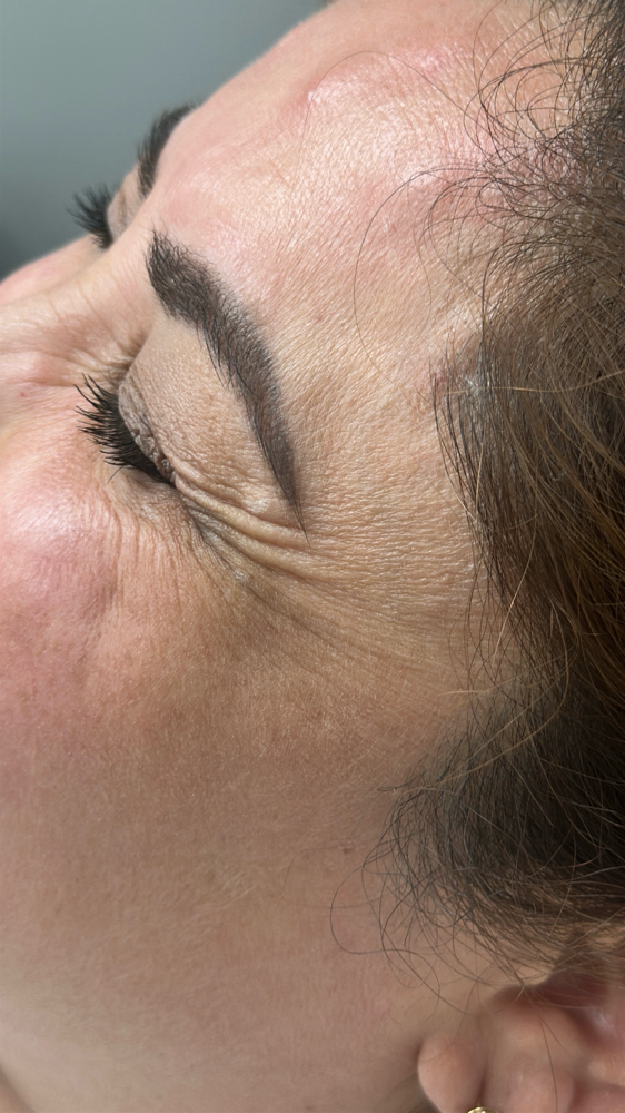 Botulinum Toxin/ Toxina Botulinica at Kimspa&beauty in Dallas, TX