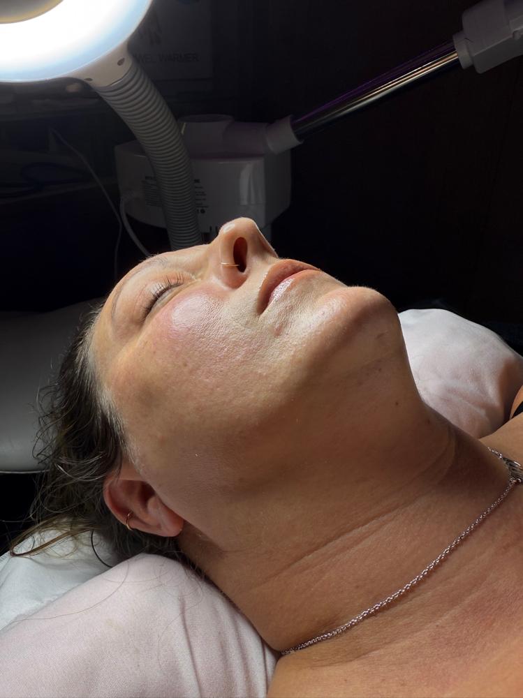 Dermaplaning Treatment